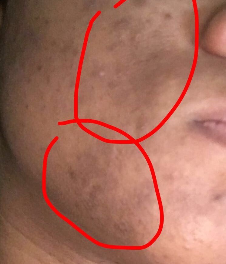 Dry Red Patch Of Skin On Face