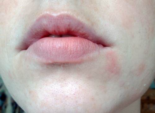 Dry Red Patch Of Skin On Face